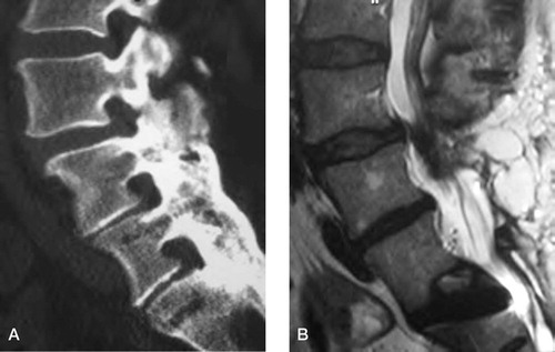 Figure 11:1 A. Computerized tomography in a patient with relapsing leg pain 12 years after decompression and fusion L4–S1. B. MRI of the same patient reveals a significant spinal stenosis of the segment proximal, adjacent to fusion with a small anterior slip of L3.