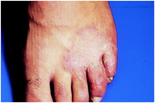 Figure 2. Tinea pedis. Annular scaly plaques involving the dorsal foot and web spaces. Reprinted with permission from: Oumeish and Parish [Citation40], with permission from Elsevier.