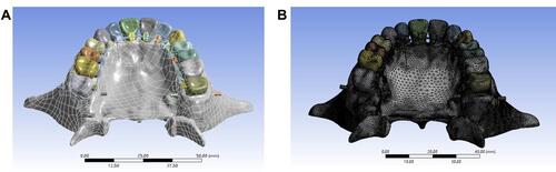 Figure 1 (A and B) Three-dimensional finite element model of implant-assisted upper dentition with lingual orthodontists.