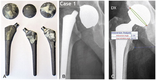 Figure 1. A. The 3 revised stems (left to right: case 1, case 2, and case 3). The bone attached to the implants is an indication of the ingrowth of the implants and the extent of bone defect caused during revision. B. Post-fracture radiograph of case 1. C. Pre-fracture radiograph of case 1. Cup angles were measured using image analysis software available at www.imatri.com (Joubert Citation2013).