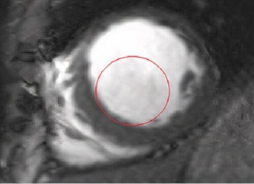 Figure 3 The patient’s cardiac magnetic resonance angiography short-axis view displaying spontaneous echo contrast (encircled in red) suggestive of the depressed left ventricular function.