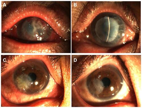 Figure 3 Representative images of graft melting. (A) At 4 months, the APCS graft had dissolved, and irreversible turbidity appeared after therapy (B) in the infectious central corneal ulcer grouper group. (C) At 3 months, the APCS graft had dissolved, and was then controlled after therapy (D) in the infectious peripheral corneal ulcer group.