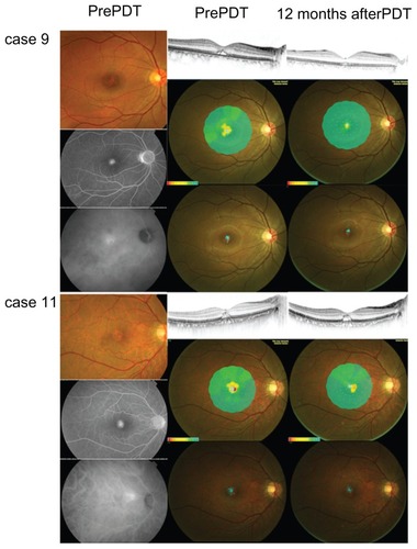 Figure 1 Representative cases with similar pretreatment findings but with different outcomes after half-dose verteporfin PDT.