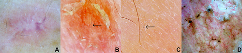 Figure 4 Dermoscopic images of some crucial features described: (A) Wickham striae, (B) morse code-like hair, (C) translucent hair, and (D) grey dots (x50 original magnification).
