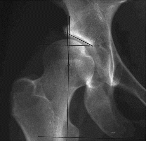 Figure 1. This figure has been cropped from an anteroposterior pelvic radiograph and only the right hip is shown. A line of reference is constructed by drawing a line going through the most caudal points on the inferior ramus bilaterally. The center-edge angle of Wiberg is constructed by drawing a line perpendicular to the line of reference through the center of the femoral head, and another line from the center of the femoral head through the lateral limit of the sclerotic acetabular roof. The acetabular index angle of Tönnis is constructed by drawing 2 lines, both originating at the medial limit of the acetabular sclerotic roof. One line runs through the lateral limit of the acetabular sclerotic roof and another is drawn parallel to the line of reference.