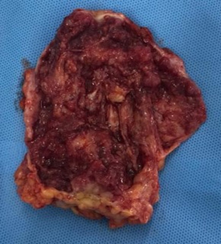 Figure 4 Macroscopic assessment of tumorectomy. Macroscopic assessment of the tumor shows wine vegetation with thick serous-bloody content. The material was friable on palpation and margins were compromised.