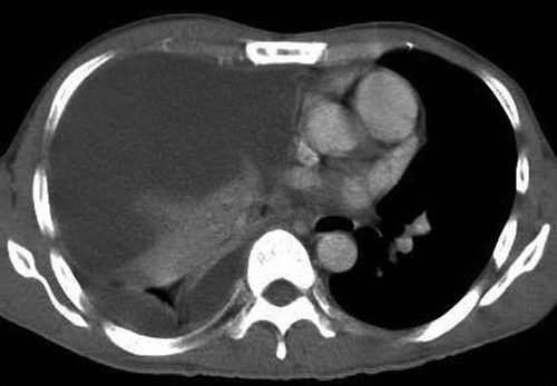 Figure 2.  Computed Tomography of the thorax showing a large right pleural effusion with shift of the mediastinum to the left (14 days after treatment with erlotinib).