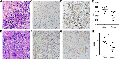 Figure 4 Hematoxylin and Eosin staining and IFIT1 typical IHC staining results and analysis. (A and B) Central nervous system tuberculosis hematoxylin and eosin (H&E) staining of lesion tissue and control tissue. (C–E) Central nervous system tuberculosis IFIT1 typical Immunohistochemistry staining. (F–H) Tuberculosis IFIT1 typical Immunohistochemistry staining. **p<0.05, The difference was statistically significant.