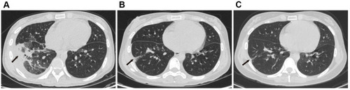 Figure 3 (A) Chest CT shows patchy infiltrates, banded and nodular shadows, pleural effusion. (A–C) Lesions in the lower lobe of the right lung and the pleural effusion absorbed gradually.
