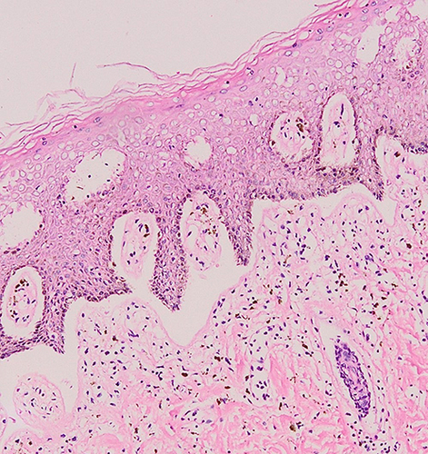 Figure 2 Histopathological examination from the labia majora revealed stromal lymphocytic infiltration.