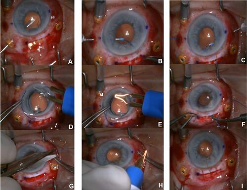 Figure 1 Key steps in the Flanged Prolene Suture intraocular lens (IOL) fixation (PIF) technique: (A) Removal IOL through large incision. (B) Docking 5–0 prolene through 27-gauge TSK needle one side. (C) Docking prolene other side. (D) Place prolene through Islet of CZBD IOL. (E) Create flange with cautery. (F) Insert IOL. (G) Cut long end of prolene ~2mm from tip. (H) Create flange with cautery and tuck into scleral opening. (I) IOL well centered, closure of scleral (or corneal) wound.