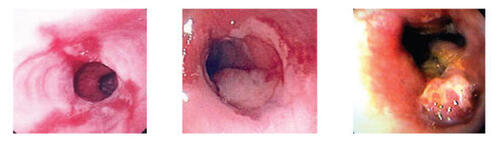 Figure 1 Progression of disease, demonstrating changes observed as esophagitis (A) undergoes metaplasia, leading to salmon-colored mucosal changes in the distal esophagus characteristic of Barrett’s esophagus (B) Dysplasia develops (C).