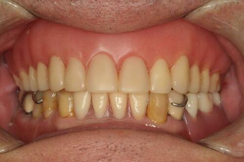 Figure 12 Frontal view with dentures.