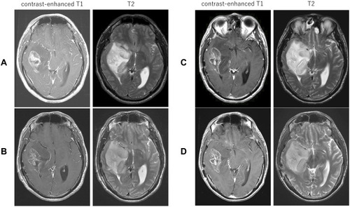 Figure 1 Magnetic resonance imaging (MRI) showing 5×3.5 cm abnormal nonuniformly contrasted mass with hypointensity on T1-weighted image (left) and with hyperintensity on T2-weighted image (right) in the right temporal lobe. (A) MRI at first consultation; (B) MRI after MPV administration (at day 17 after admission); (C) MRI after FCR administration (at day 34 after admission); (D) MRI after Ibr administration (at day 54 after admission).