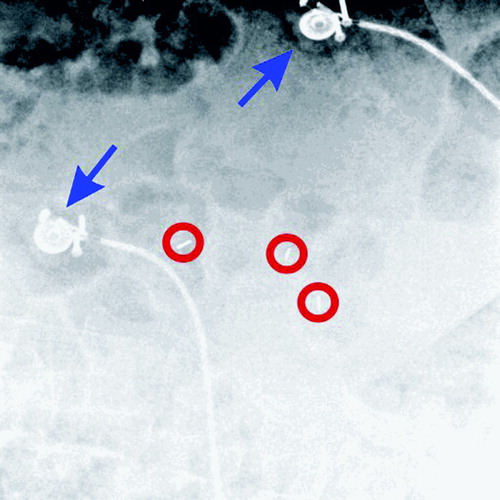 Figure 3. Live X-ray to determine the target position, using gold markers (circled in red) and infrared emitters (indicated by blue arrows). [Color version available online.]