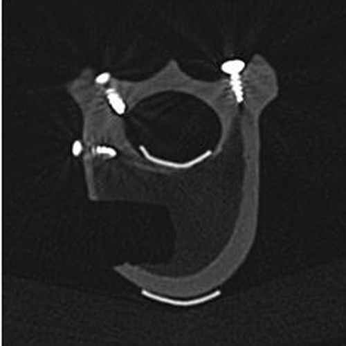Figure 6. A slice of the post-operative CT scan, showing the formed graft bed and the fiducial markers.