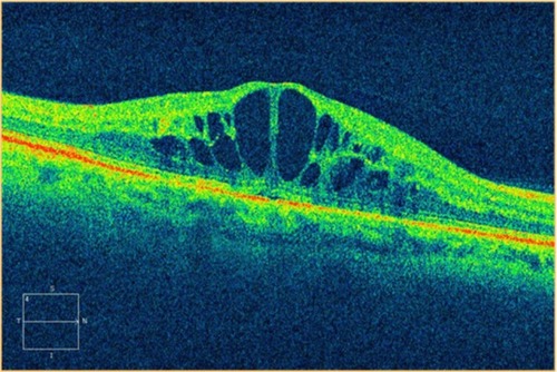 Figure 25 Cirrus™ optical coherence tomography image.