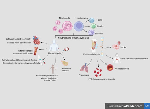 Figure 1. Diagram of potential clinical applications of the neutrophil-to-lymphocyte ratio in the diagnosis and prognosis of complications associated with hemodialysis and peritoneal dialysis. EPO, erythropoietin; NK cells, natural killer cells.