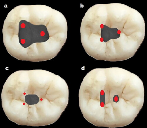 Figure 2. Occlusal view in lower molar tooth: (a) traditional endodontic access cavity illustration; (b) conservative endodontic access cavity; (c) ultraconservative endodontic access cavity; (d) truss endodontic access cavity.