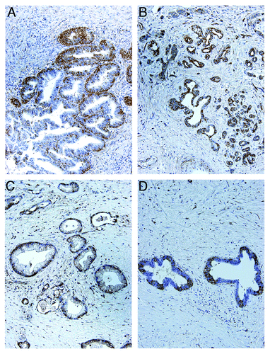 Figure 3. Expression of TRPM8 in pancreatic adenocarcinoma tissues. Surgically resected specimens were embedded in paraffin and processed for immunohistochemistry using rabbit anti-human TRPM8 antibodies (Lifespan Biosciences) followed by incubation with horseradish peroxidase-conjugated anti-rabbit IgG (EnVision+ System, Dako). The signals were detected by color reaction using 3,3′-diaminobenzidine (Dako), counterstained with hematoxylin (Richard-Allan Scientific), and mounted using Permount (Sigma). The brown color indicates the presence of TRPM8 protein. Note the heterogeneity for expression of TRPM8 in the tumors. Controls using the consecutive tissue sections for each paraffin block were processed in the absence of anti-TRPM8 antibodies, and no immunoreactivity against TRPM8 was detected (data not shown). The panels A though D correspond to the patients as described in Table 1.