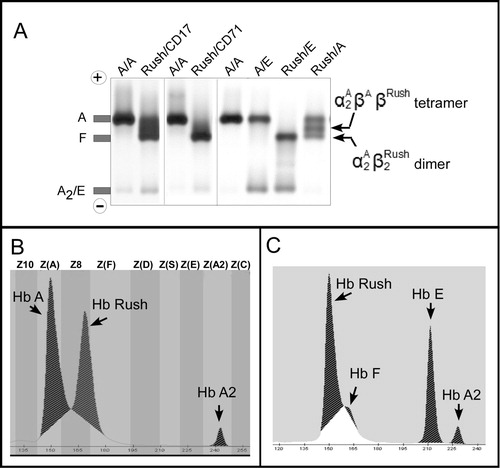 Figure 2. Representative hemoglobin separation profiles of Hb Rush carriers. A: Agarose gel electrophoresis shows hemoglobin separation patterns of normal β alleles (A/A), heterozygote of Hb E (A/E), compound heterozygotes of Hb Rush with β0-thalassemia (Rush/CD17 and Rush/CD72) and Hb E (Rush/E), and simple heterozygote of Hb Rush (Rush / A). Hb Rush dimer and tetramer fractions migrate into the Hb F region. B: Capillary electrophoretic pattern of a simple heterozygote of Hb Rush. Hb Rush migrates into the Z8 zone. C: Capillary electrophoretic pattern of a compound heterozygote of Hb Rush and Hb E showing a significant proportion of Hb Rush and absent Hb A distinguishing from slightly increased Hb F. Hemoglobin fractions and migration zones were not automatically determined, owing to the loss of the Hb A fraction as reference for interpretation.