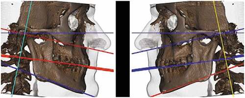 Figure 2. Images and measurements obtained by the SYM 3D protocol evaluating the sagittal relationship between the maxilla and mandible.