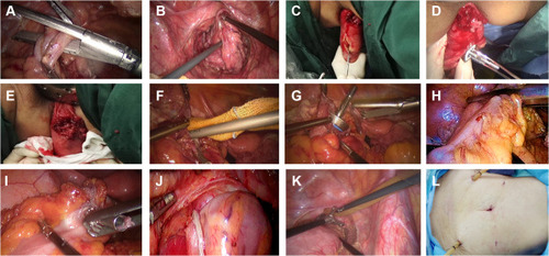 Figure 1 Specimen removal and gastrointestinal reconstruction of low rectal cancer in NOSES group. (A) Cut and closed sigmoid colon. (B) The specimen was pulled out of the body through the anus. (C) Cut through the rectal wall. (D) Sent the nail base into the pelvic cavity through the anus. (E) The specimen was resected by means of kaito. (F) Cut the wall of sigmoid colon and sterilize it. (G) The nail base was placed into the proximal sigmoid colon. (H) Closed sigmoid wall. (I) Removed the connecting rod of the nail seat. (J) An end-to-end anastomosis was performed. (K) Bilateral drainage tube was inserted. (L) Postoperative abdominal wall of the patient.