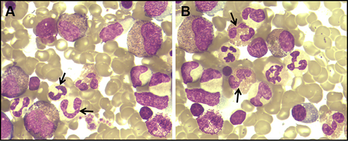 Figure 2 Bone marrow smear of Loeffler endocarditis. (A) Active myeloid proliferation, marked eosinophilia without abnormal myeloid cells (arrow); (B) Morphology of degranulated eosinophils (arrow).