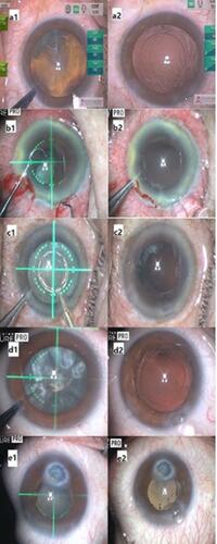 Figure 2 Precision pulse capsulotomy (PPC) in patients with anterior subcapsular opacity (a1: before capsulotomy; a2: after capsulotomy); a poorly dilated pupil (b1: before capsulotomy; b2: after capsulotomy); white cataract (c1: before capsulotomy; c2: after capsulotomy); brunescent cataract (d1: before capsulotomy; d2: after capsulotomy); and corneal opacity with a poorly dilated pupil (e1: before capsulotomy; e2: after capsulotomy).