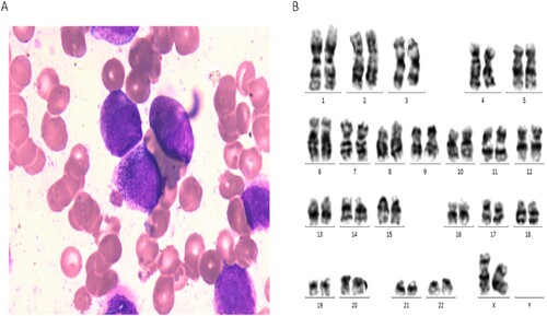 Figure 1. Morphology, cytogenetic and molecular analysis of the RARG-HNRNPM fusion gene. (A) BM smear morphology; (B) Chromosome analysis of the patient.