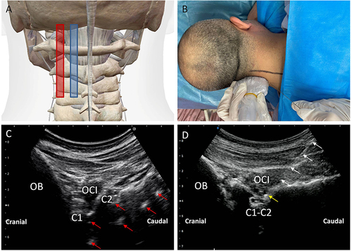Figure 1 Transducer position and corresponding ultrasound image of C2 DRG. (A) Anatomical diagram of ultrasonic probe placement. (B) Patient’s position and performance of the C2 DRG puncture using longitudinal scanning with needle in-plane approach. (C) Ultrasound images of upper cervical spinal canal structure. (D) Ultrasound images for the C2 DRG puncture. (Red arrow, posterior and anterior complex; White arrow, needle; Yellow arrow, needle tip; OB, Occipital bone; C1, the posterior arch of atlas; C2, lamina of axis; C1-C2, lateral AA joint; OCI, obliquus capitis inferior muscle).