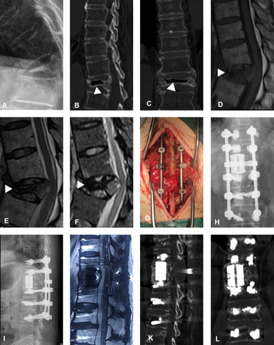 Figure 4 An 82-year-old female patient experienced Kümmell’s disease complicated by neurological deficits and used a 3D-printed artificial vertebral body (3DP-AVB). (A) T11 collapsed fracture was shown in preoperative X-rays. (B and C) Coronal and sagittal CT showed an intravertebral cleft (IVC) (white triangle). (D–F) MRI showed a decreased signal in IVC (white triangle). (G) Intraoperative images. (H and I) Immediate postoperative X-rays showed that a 3DP-AVB was implanted. (J) Postoperative sagittal T2-weighted MRI showed a sufficient spinal cord decompression. (K and L) Coronal and sagittal CT showed that no subsidence occurred at the final follow-up.