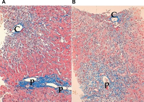 Figure 1 Two types of centrilobular zonal necrosis (CZN).