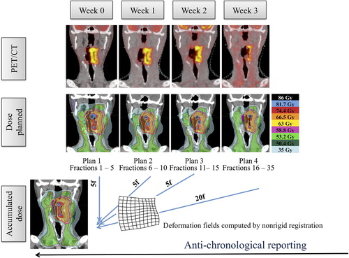 Figure 2. Design of the dose adaptation procedure. Separate image sets (pre-treatment and after 5, 10 and 15 fractions of RT) were acquired for each planning phase. Using deformable image co-registration, volumes-of-interest (CTVs and OARs) were deformed from one CT to the next and manually adjusted when needed. A PTVPET and sub-contours for DP were created from each new PET image and incorporated to the deformed CTVs and OARs. For each phase, a new treatment plan was made. Dose summation was performed anti-chronologically on the pretreatment PET-CT.