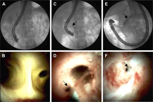 Figure 3 Endoscopic diagnosis of pancreatic duct stricture and APBJ.Notes: Initial ERCP image following cannulation of major papilla revealed SpyGlass cholangioscopy entering CBD (A). The SpyGlass cholangioscopy image presented normal structures of both left and right bile ducts (B). As the SpyGlass cholangioscopy retreated along CBD (C). The arrow in (C) indicates the head of Spyglass cholangioscopy. The opening of MPD was detected joining distal CBD, suggesting possible APBJ (P-B type). (D). The arrow in (D) indicates the opening of MPD ERCP image with cannulation of minor papilla indicated a dilated and beaded pancreatic duct with stricture in pancreatic body duct (E). The SpyGlass pancreatoscopy study demonstrated extremely stenotic ring in pancreatic body duct (F). The arrow in (E) and (F) indicate the stenotic site.Abbreviations: APBJ, anomalous pancreaticobiliary junction; CBD, common bile duct; ERCP, endoscopic retrograde cholangiopancreatography; MPD, main pancreatic duct.