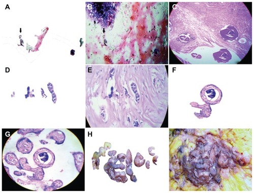 Figure 5 Embryoid bodies have the capability to generate fractal and mirror images. (A) Detachment subimage of (B) image revealing fractal components which converge in well-developed embryoid body in a case of peritoneal carcinomatosis ascitic fluid, Papanicolaou staining (20×). (C) Composite image that shows detachment mirror embryoid bodies taken from their original tissue position, in a case of prostatic intraepithelial neoplasia. (D) Detachment subimage of (E) showing alignment fractal copies of embryoid bodies in a case of breast adenocarcinoma, hematoxylin and eosin staining (20×). (F) Detachment subimage of (G) showing fractal embryoid within another one, in a case of gestational trophoblastic disease, hematoxylin and eosin staining (20×). (H) Detachment subimage of (I) showing macroscopic fractal components of embryoid bodies in a case of breast adenocarcinoma.