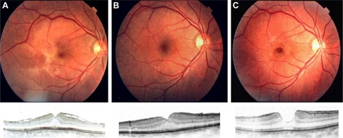 Figure 3 Recurrence of ERM in the macula after successful removal of idiopathic ERM by vitrectomy. Vitrectomy for idiopathic ERM was performed and visual acuity improved from 20/30 (A) to 20/20 (B). However, it reoccurred 1 year after the vitrectomy and the visual acuity decreased to 20/30 (C).