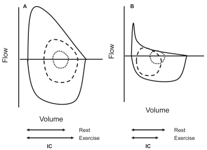 Figure 4 Maximum and tidal flow-volume curves in subjects with and without flow limitation. In this figure it can be seen an schematic representation of the spontaneous flow-volume curves generated at tidal volume at rest (inner dotted line ····) and peak exercise (dashed line ----) compared with the maximum flow volume curve in a subject without flow limitation able to reduce its end-expiratory lung volume (Panel A) and a flow-limited COPD patient with dynamic hyperinflation (Panel B).