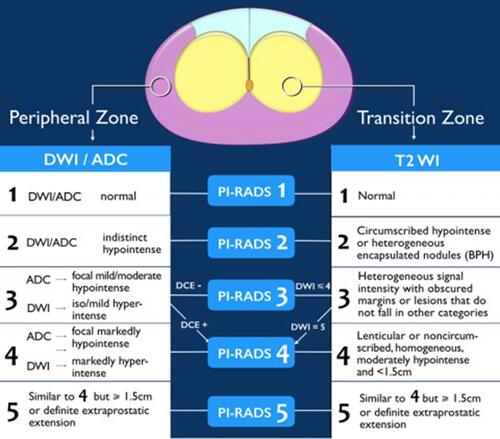 Figure 1 PIRADS VERSION 2 (American College of Radiology. Prostate Imaging – Reporting and Data System. 2019. Version 2.1. PIRADS).