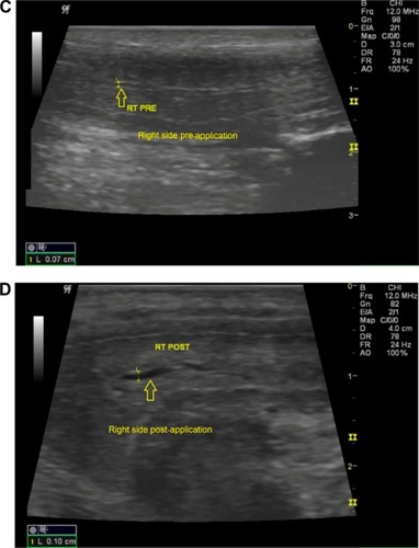 Figure 5 (A) Doppler ultrasound image showing the diameter of the left side of cavernous artery (arrow) of a normal patient before the application of TPH gel. (B) Doppler ultrasound image showing the diameter of the left side of cavernous artery (arrow) of a normal patient 1 hour after the application of TPH gel. (C) Doppler ultrasound image showing the diameter of the right side of cavernous artery (arrow) of a normal patient before application of TPH gel. (D) Doppler ultrasound image showing the diameter of the right side of cavernous artery (arrow) of a normal patient 1 hour after the application of TPH gel.