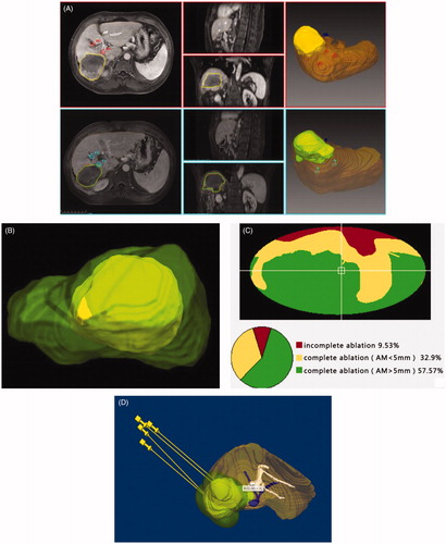 Figure 3. A 53-years male with single HCC (8.4 × 6.2 × 6.4 cm) Screenshots shows procedure for three-dimensional visualization imaging fusion and tumor map generation. (A) The junction between the portal vein and the hepatic fissure as an appropriate landmark was selected (circle cross indicate). (B) During the procedure of -dimensional visualization imaging fusion, a part of the tumor appear outside the ablation area . (C) Tumor map showed the proportion of various parts of the tumor in the ablation area. (D) According to 3D fused image and tumor map, a new preoperative planning is performed again.