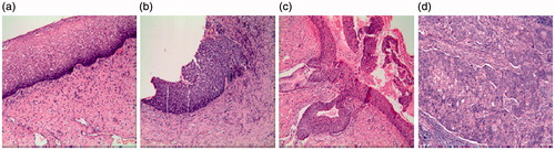 Figure 2. The CIN grading image samples. (a)Normal, (b) CINII, (c) CINIII, (d) Cervical Cancer.