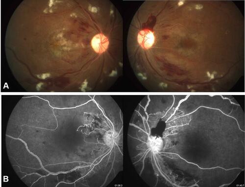 Figure 2 Clinical picture (A) fundus fluorescein angiography (B) demonstrating severe macular ischemia in a case of radiation retinopathy.