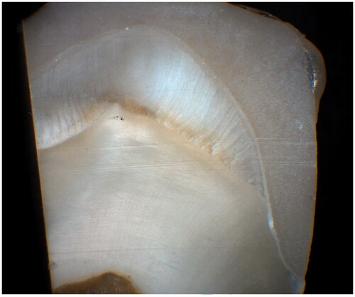 Figure 2. Sectioned tooth after cementation.