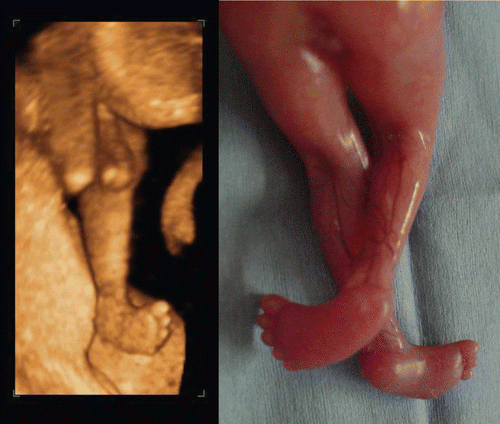 Figure 44.  Fetal clubfoot at 13 weeks of gestation Left; 3D image of fetal leg. Right; Legs of aborted fetus. This case was associated with chromosomal aberration.