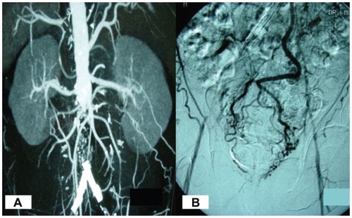 Figure 2 Computerized tomography angiogram A) and angiography B) of case 2 patient showing complete occlusion of infrarenal aorta with reconstitution at femoral vessels, and occluded iliac stents B).