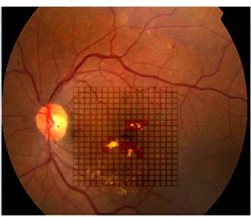 Figure 3 The color palette is used to mark the area of micropulse laser applied to the fundus by the surgeon immediately after the treatment session. Different colors can be used for variable power settings in each session and also for different sessions.