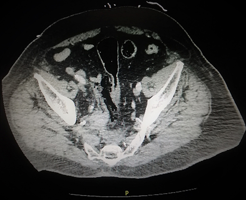 Figure 1 Abdominal and pelvic CT scan of a 75-year-old man showing a perforation of the anterior wall of the rectum.