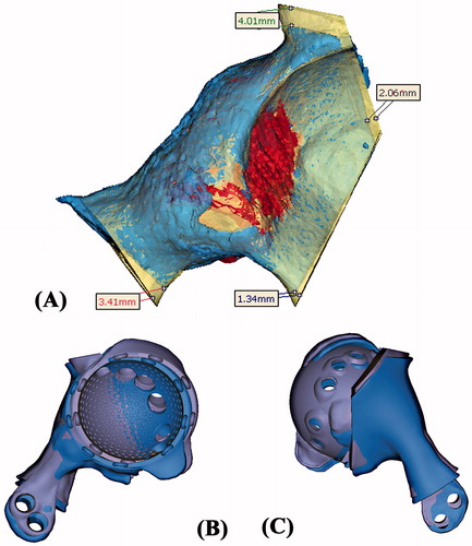 Figure 7. (A) The CT images of the resected tumor specimen (blue in color) were compared with that of the surgical planning (yellow and red in color). The errors of the achieved resections were ranged from 1.3 to 4.0 mm. (B and C) The achieved implant position (blue in color) was comparable with the planned (purple in color). The deviations of achieved cup orientation and position are summarized in Table 1.
