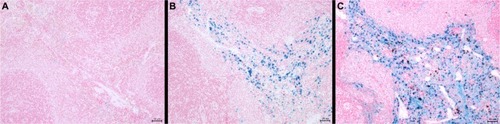 Figure 9 The amount of iron in the spleen of 12-week-old and 25-week-old control rats compared with a 25-week-old rat injected with SPION microbubbles as visualized using Perl’s Prussian blue staining. (A) The spleen of a 12-week-old control rat (untreated) shows a limited amount of iron, while (B) in the 25-week-old control rat, the amount of iron was increased. (C) Shows the amount of iron found in the spleen of the 25-week-old rat injected 6 weeks previously with SPION microbubbles, that was considerably higher compared with the untreated control.Abbreviation: SPION, superparamagnetic iron oxide.